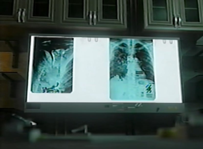 X-rays of a persons' lungs in the video Backrooms - Autopsy Report